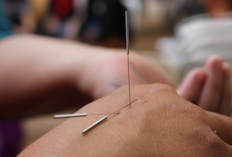 Acupuncture vs. dry needling how to choose? Health Facts Time